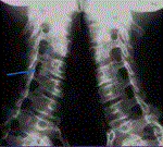 Hình ảnh giải phẫu X-quang cột sống