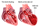 Bệnh cơ tim dãn (Dilated cardiomyopathy - DCM) )