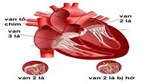 Bệnh cơ tim hạn chế (Restrictive cardiomyopathy - RCM) 