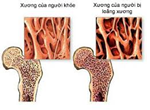 Vai trò dấu ấn chu chuyển xương trong theo dõi đáp ứng điều trị loãng xương