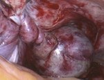 U nang buồng trứng, chẩn đoán và điều trị