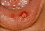 Viêm miệng Áp - tơ - RAS (Recurrent Aphthous Stomatitis)