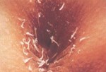 Bệnh giun Kim (Enterobius vermicularis)