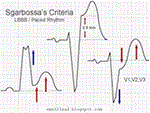 HC Romano-Ward; Sgarbossa's criteria; Tako Tsubo trên điện tâm đồ