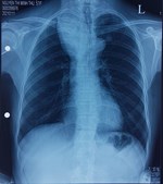 Bóng bờ Felson trên phim X-quang lồng ngực
