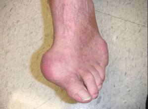 Có những điểm mạnh và hạn chế nào của xquang gout?
