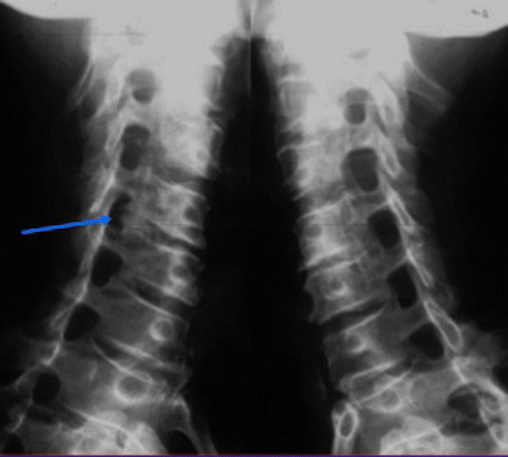 Đặc điểm và phương pháp giải phẫu x quang cột sống thắt lưng hiệu quả