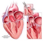  Chết đột ngột khi hoạt động gắng sức - Bệnh cơ tim phì đại (hypertrophic cardiomyopathy - HCM)