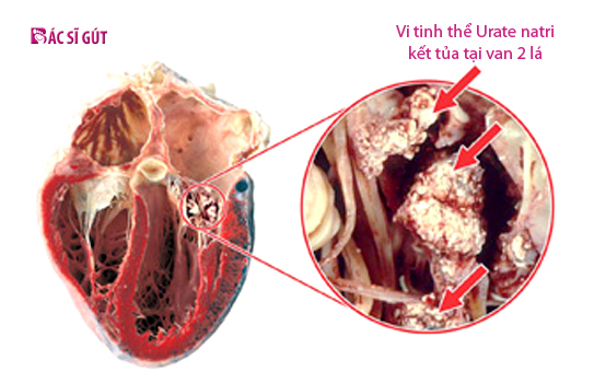 Làm thế nào purin ảnh hưởng đến cơ chế gây bệnh gout?
