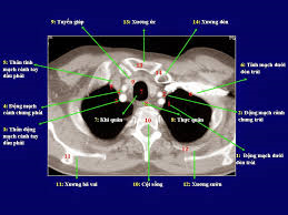 What are the anatomical structures observed in a lung CT scan?