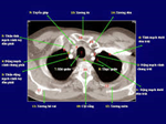 Hình ảnh giải phẫu CTscan lồng ngực