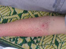 Tại sao dấu hiệu lacet là một trong những chỉ báo cần chú ý trong việc chẩn đoán bệnh sốt xuất huyết?
