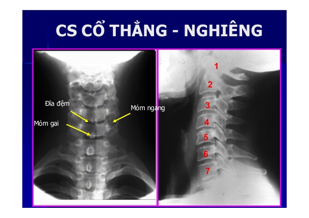 Hình ảnh thoái hóa cột sống trên phim X-quang - PGS Hà Hoàng Kiệm