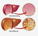 Bệnh gan nhiễm mỡ (Fatty liver disease)