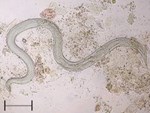 Bệnh giun lươn (Strongyloides Stercoralis)