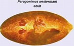 Bệnh sán lá phổi (Paragonimus)