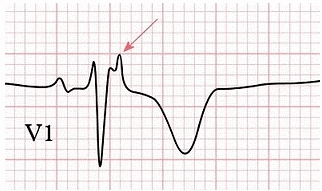 Sóng Epsilon trên điện tâm đồ và bệnh ARVD - PGS Hà Hoàng Kiệm