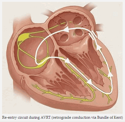 Hội chứng WPW type B có liên quan đến các bệnh tim khác không?
