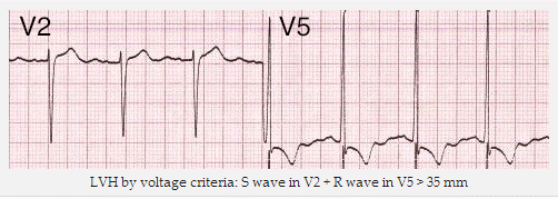 Điện tim dày thất trái là biểu hiện như thế nào trên đồ điện tâm đồ?
