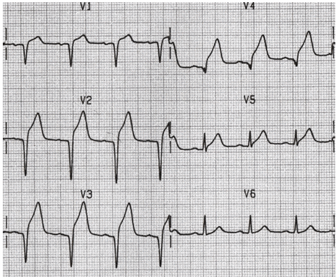 Tại sao sóng Q hoại tử xuất hiện trong điện tâm đồ là dấu hiệu của nhồi máu cơ tim?