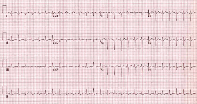 ECG viêm cơ tim là gì?
