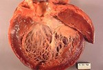 Bệnh cơ tim chu sản