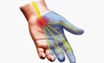 Hội chứng ống cổ tay (Hội chứng đường hầm cổ tay)