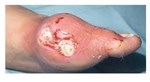 Krystexxa (pegloticase): thuốc mới điều trị bệnh Gout