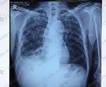 Chẩn đoán và điều trị lao phổi