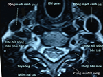 Cách đọc phim MRI (cộng hưởng từ) thoái hóa và thoát vị đĩa đệm cột sống cổ