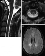 Hình ảnh MRI các bệnh lý tủy sống do hủy myelin