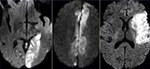 MRI khuếch tán (DWI) trong chẩn đoán nhồi máu não cấp