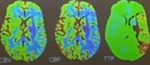 MRI tưới máu não (Perfusion) trong chẩn đoán nhồi máu não cấp