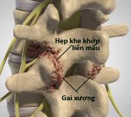 Những phương pháp điều trị hiệu quả cho viêm khớp liên mấu là gì?
