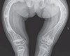 Bệnh xương thủy tinh (Osteogenesis Imperfecta)