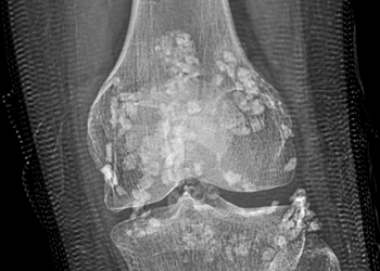 Nhân một ca bệnh hiếm gặp (Synovial Osteochondromatosis)
