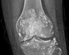 Nhân một ca bệnh hiếm gặp (Synovial Osteochondromatosis)
