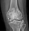 Nhân một ca bệnh hiếm gặp (Synovial Osteochondromatosis)